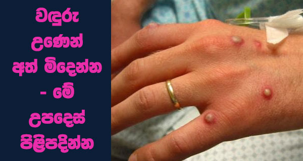 වඳුරු උණෙන් අත් මිදෙන්න – මේ උපදෙස් පිළිපදින්න